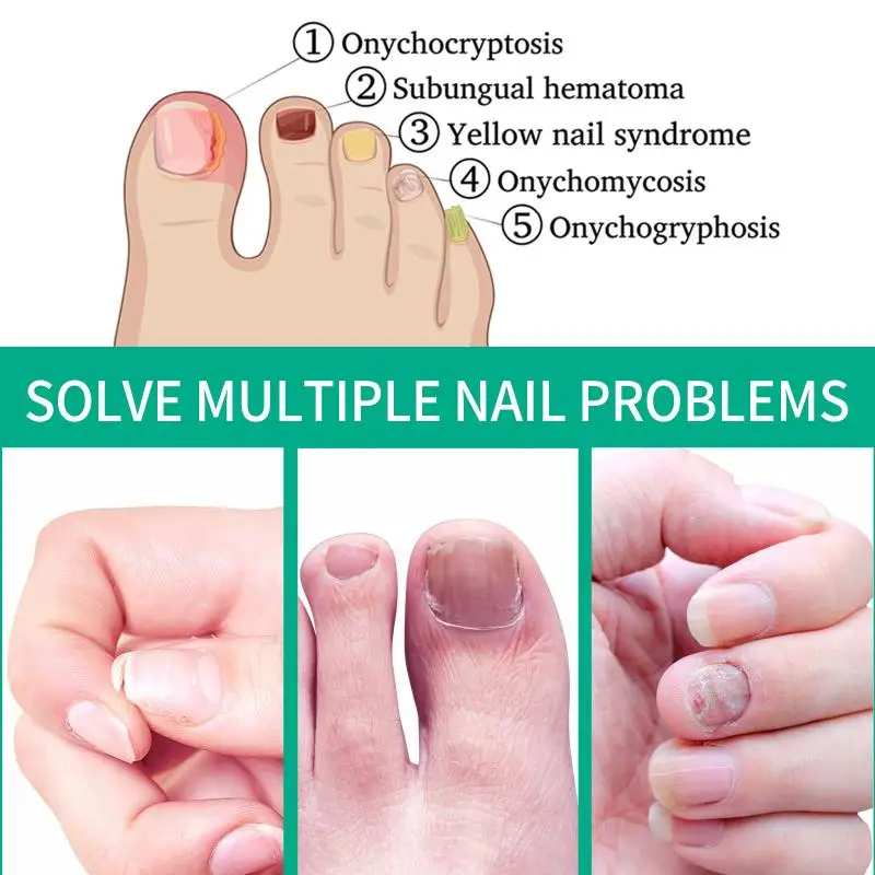 Extra Strong Nail Fungus  Serum  oil Repair Removal Fungal Feet Nails Care Toe Anti Infection Cream Essenc