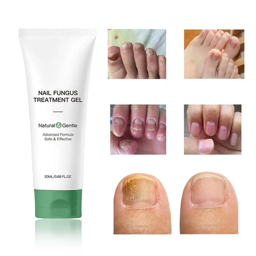 20ML Nail Repair Gel Foot Care Removal Repair Gel Natural Plant Formulas Foot Nail Fungus Essential Onychomycosis Nail Care