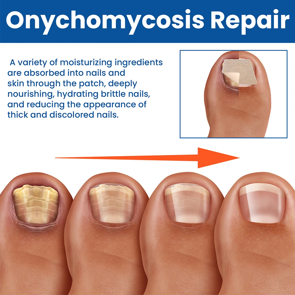 60Pcs Toenail Fungus Patch Sticky Nail Repair Patches Nail Ingrown Correction Stickers for Discolored Or Damaged Nails