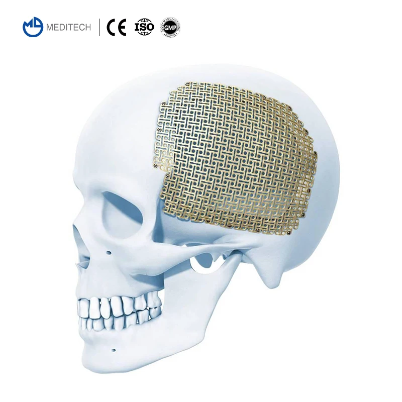 MEDITECH Orthopedic Surgical Maxillofacial Neurosurgery System Cranial Implant Titanium Mesh Plate for Skull Cranioplasty