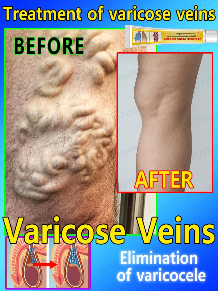 Varicose vein ointment, repair varicose veins and vasculitis