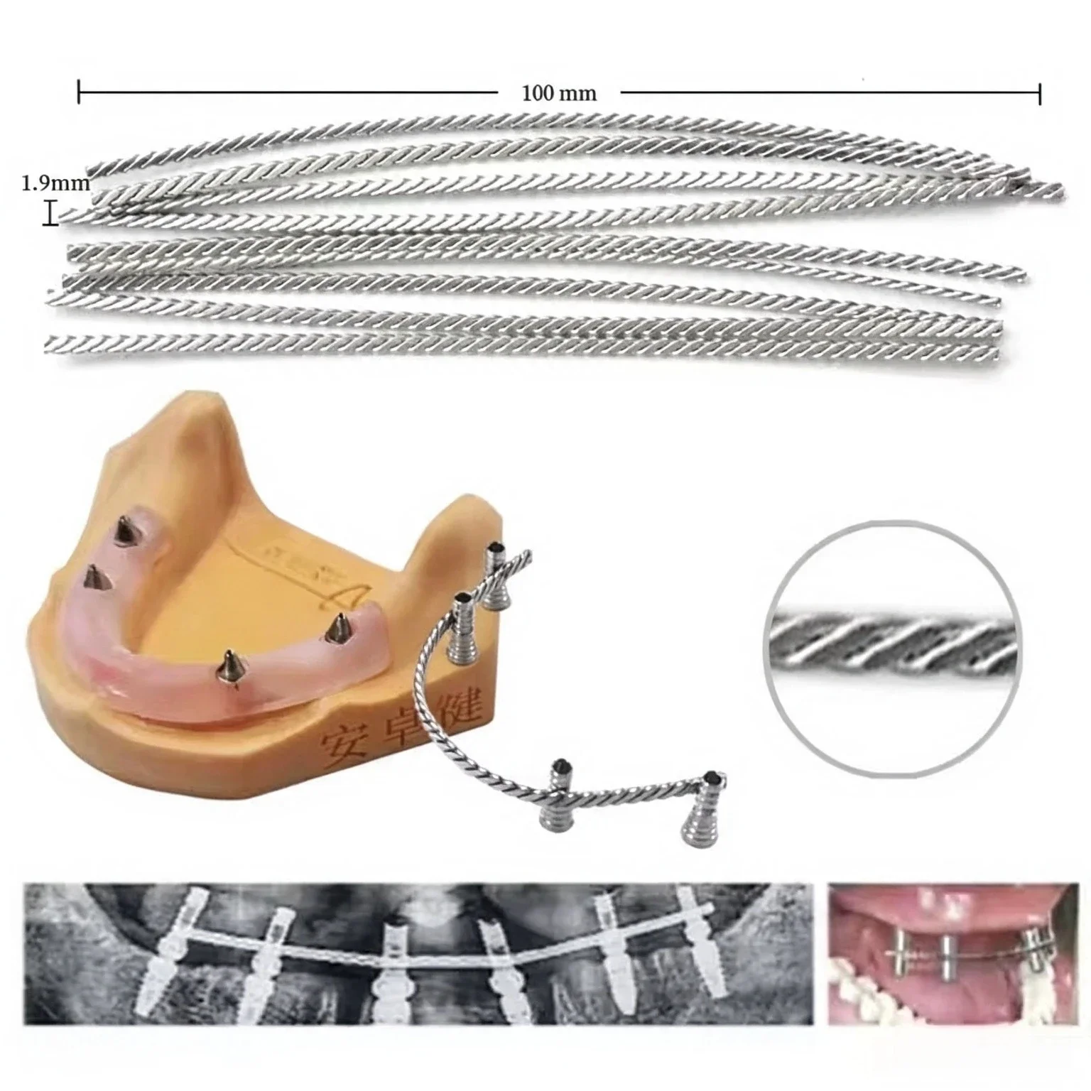 30Pcs Dental Implant Connector Stainless Wire for Overdenture MU Impant Wire can be Welded or Bonded MU Wire Strengthener