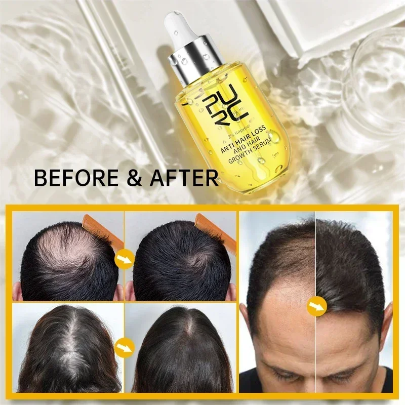 PURC Serum penumbuh rambut pria wanita, produk Serum Kecantikan Kesehatan rambut rontok Anti minyak rambut tumbuh jahe untuk pria dan wanita 2023