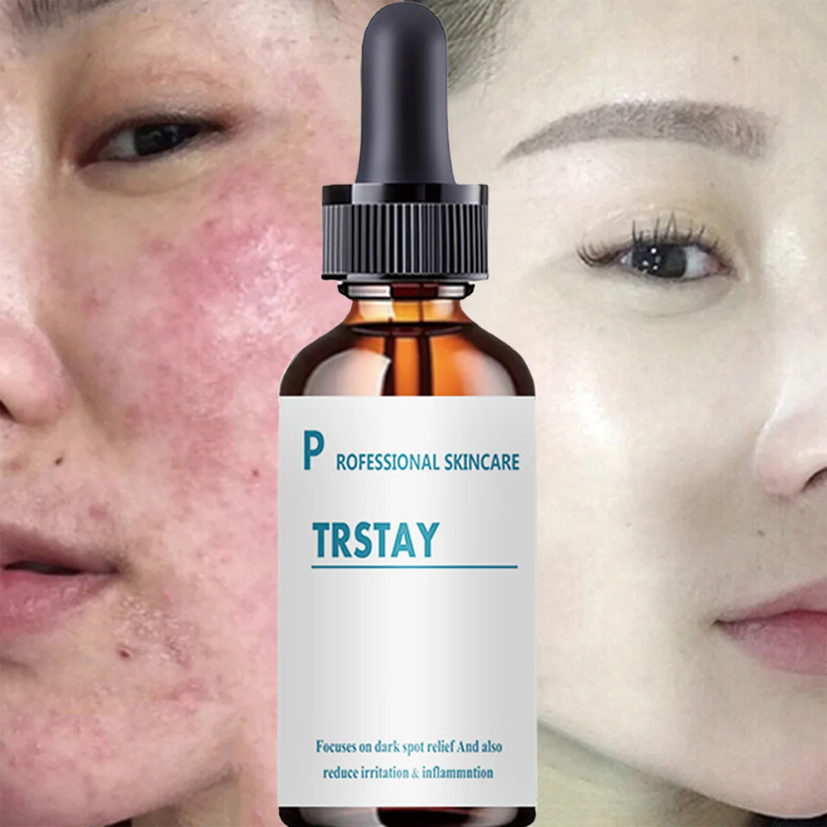 

TRSTAY Эссенция для лица, удаление пятен и прыщей, облегчение темных пятен, воспаление и раздражение, уменьшение ухода за кожей для мам и детей