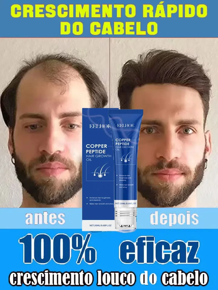 إنتاج Nsucciss،99% des acheteurs acheteurs achéteront ànouveau، its ont de plus en plus de cheveux، disent Alfa à la calvitie، Cheveux épais