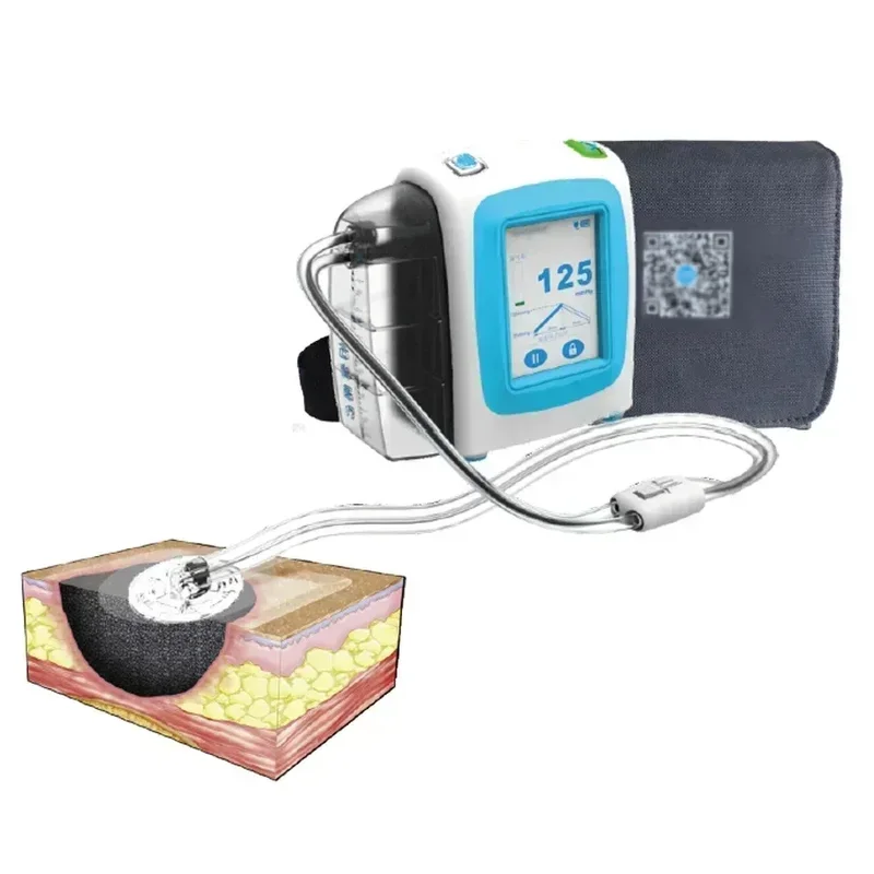 Portable NPWT Negative Pressure Wound Therapy Designed For The Ambulatory Patient