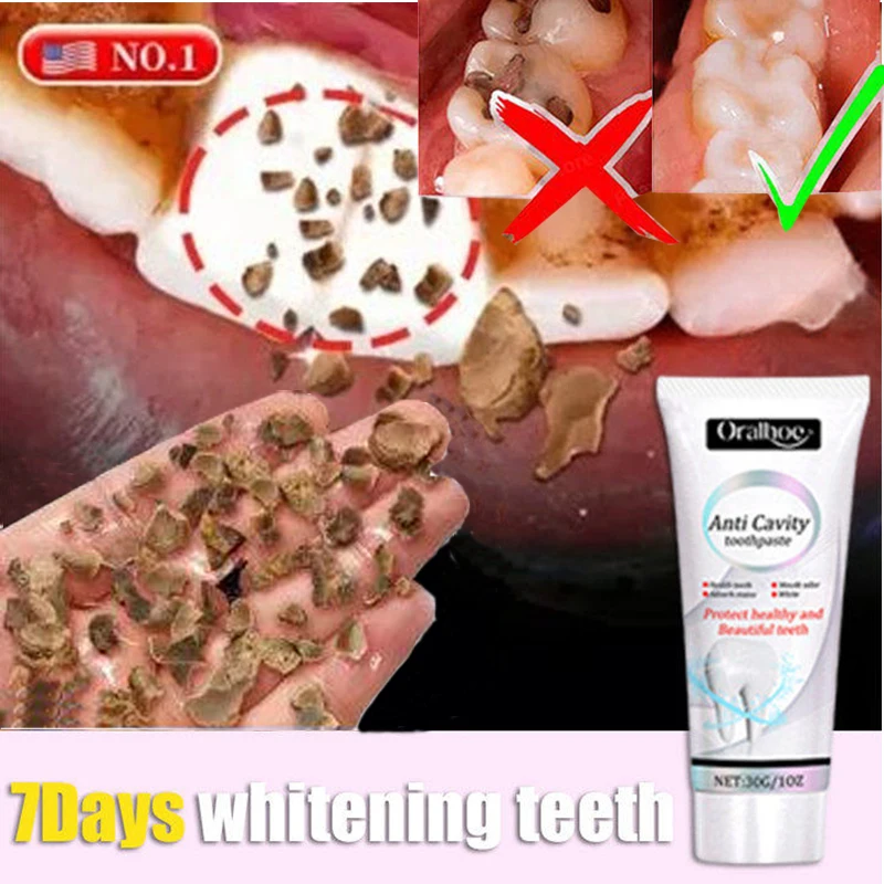 Useful Toothpaste Prevent Repair Tooth Decay Remove Plaque Relieve Periodontitis Toothache Freshen Whiten Teeth Bad Breath