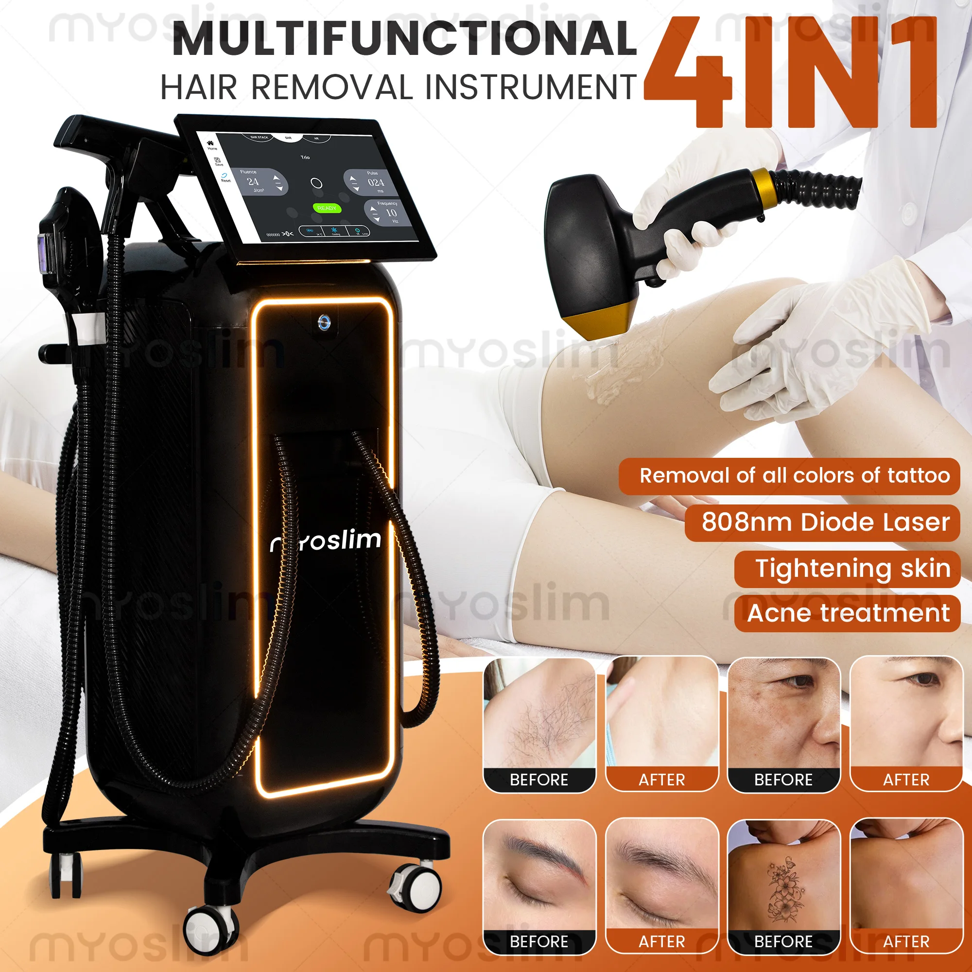 Soprano 4 in 1  Diode Hair Rem - đánh giá và giá Industrial Laser Cleaning Machine