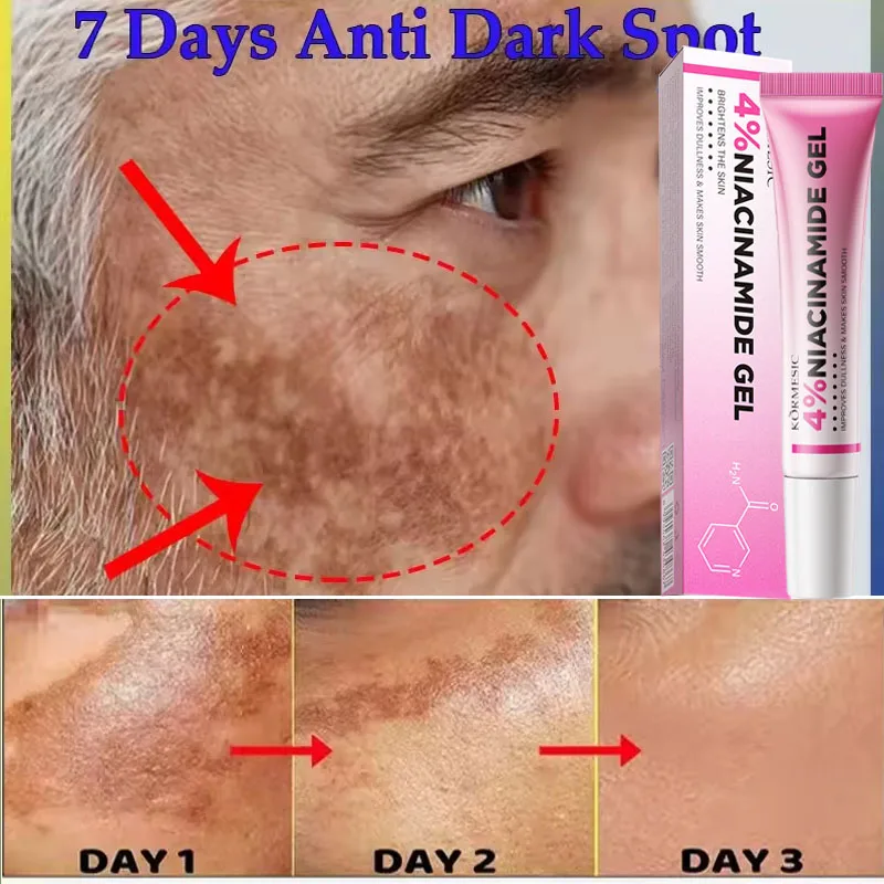 

Nicotinamide Whitening Freckles Cream Dark Spot Corrector Remove Melasma Fade Melanin Pigmentation Brighten Skin Care Products