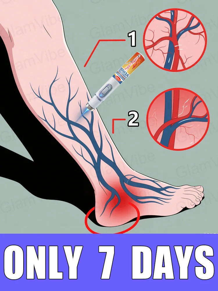 

Generation-2 Laser Says Goodbye To Spider Legs Varicose In 7 Days