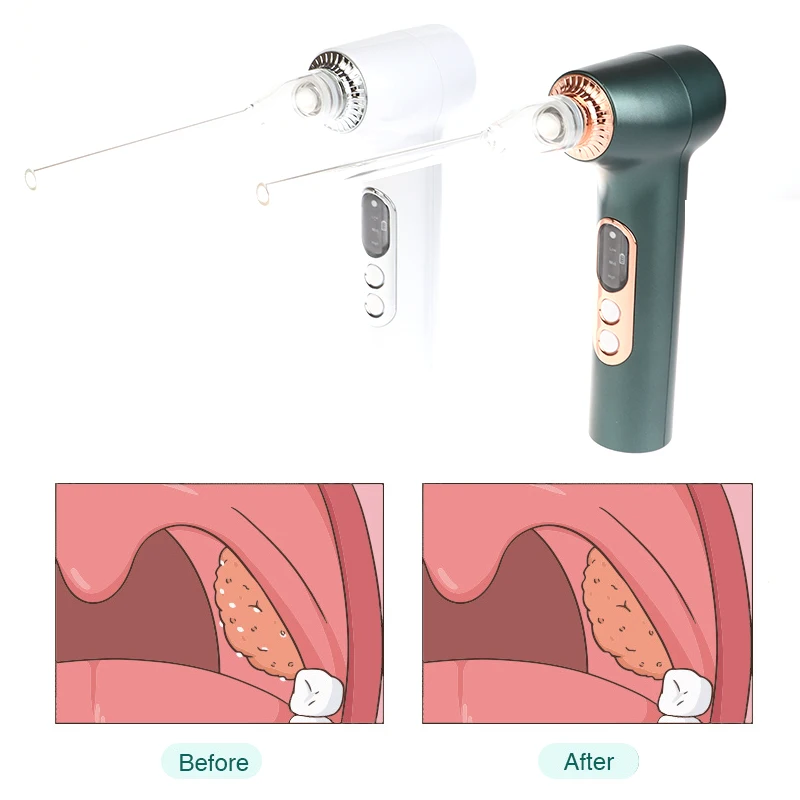 Electric Tonsil Stone Remover Tonsil Stone Removal Kit Vacuum With Irrigation Syringe Instant Suction Tonsil Stone Removal