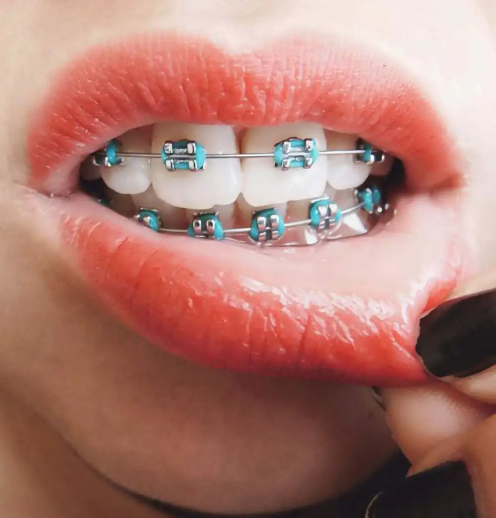 Mehrfarbige orthodontische elastische O-Ring-Gummibänder, mehrfarbige zahnärztliche Ligatur-Gummibänder, orthodontisches Ligaturring-Set - O-Ring-Zahnligaturringe für orthodontische Behandlung und Zahnspangen, 48 Farbe – Detail 17