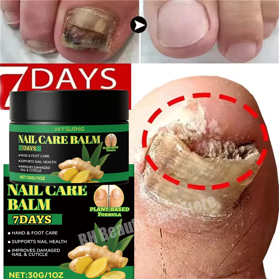 Nagel Schimmel Behandeling Crème Voet Teen Nagel Schimmel Verwijdering Essentiële Olie Anti Infectie Onychomycose Paronychia Repareren Zorg