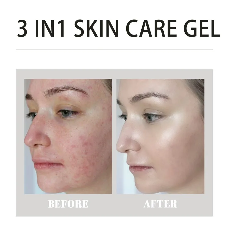 3 em 1 acne cuidados com a pele gel controle de óleo limpeza profunda clareamento acne cravos marcas hidratante suavização gel de reparação da pele