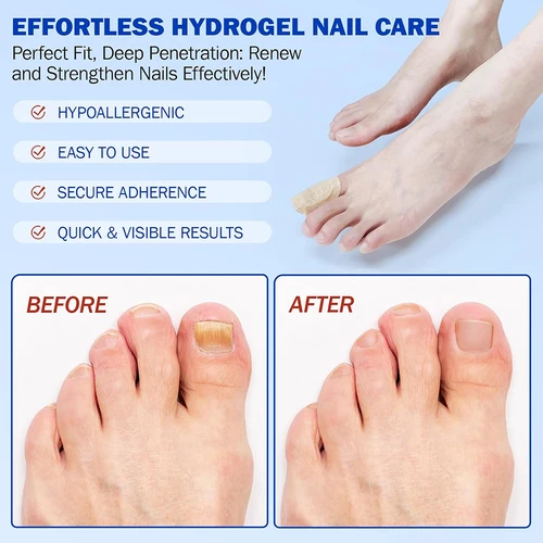 Imagen 2 del producto Parche de reparación de uñas, hongos grises, tratamiento de paroniquia suave espesante, pegatina de corrección antiinfección, cuidado de uñas encarnadas