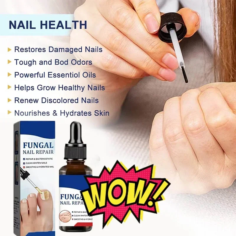 مرحبا الفطرية علاج الأظافر جوهر النفط فطريات الأظافر جهاز الليزر إصلاح أظافر أظافر علاج فطار الأظافر مع الفطر