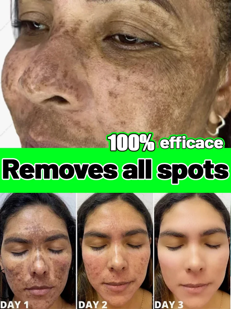 

No more spots Effectively resolves pigmentation