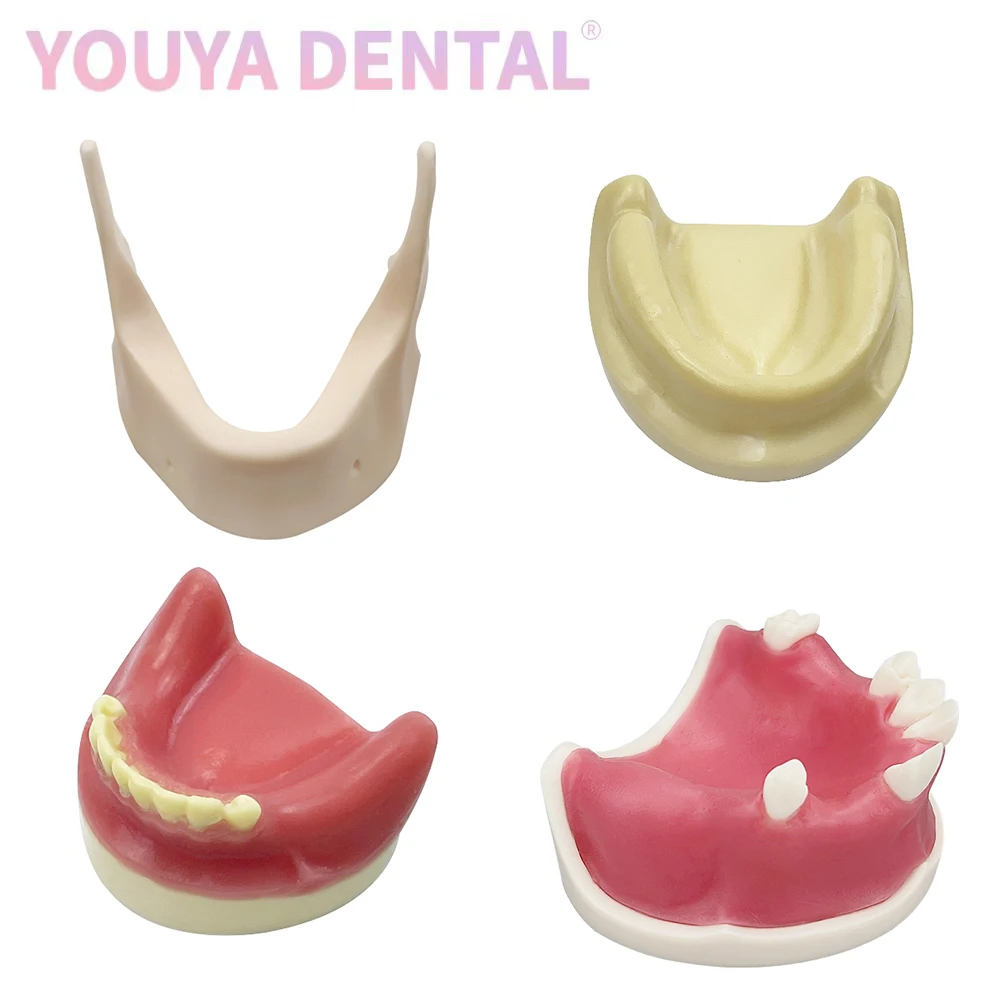 Dental Implant Practice Model Maxillary Mandibular Basic Implant Training Model With Soft Gums Suitable For Students To Practice