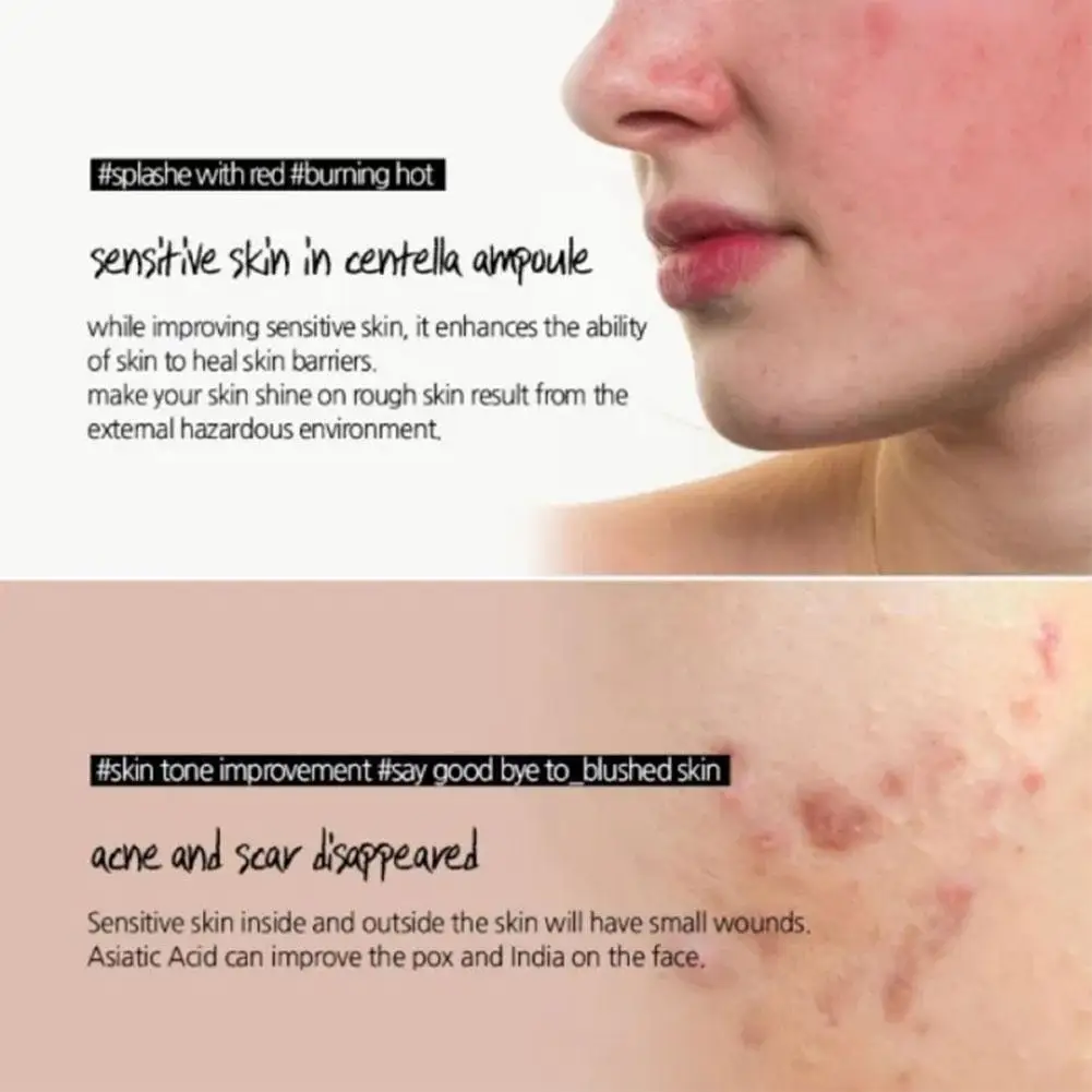 Toner Bottle Centella Asiatica Ampoule Oil Control Remove Acne And Moisturize Facial Care Lotion Firming Wrinkles Liquid 100ml
