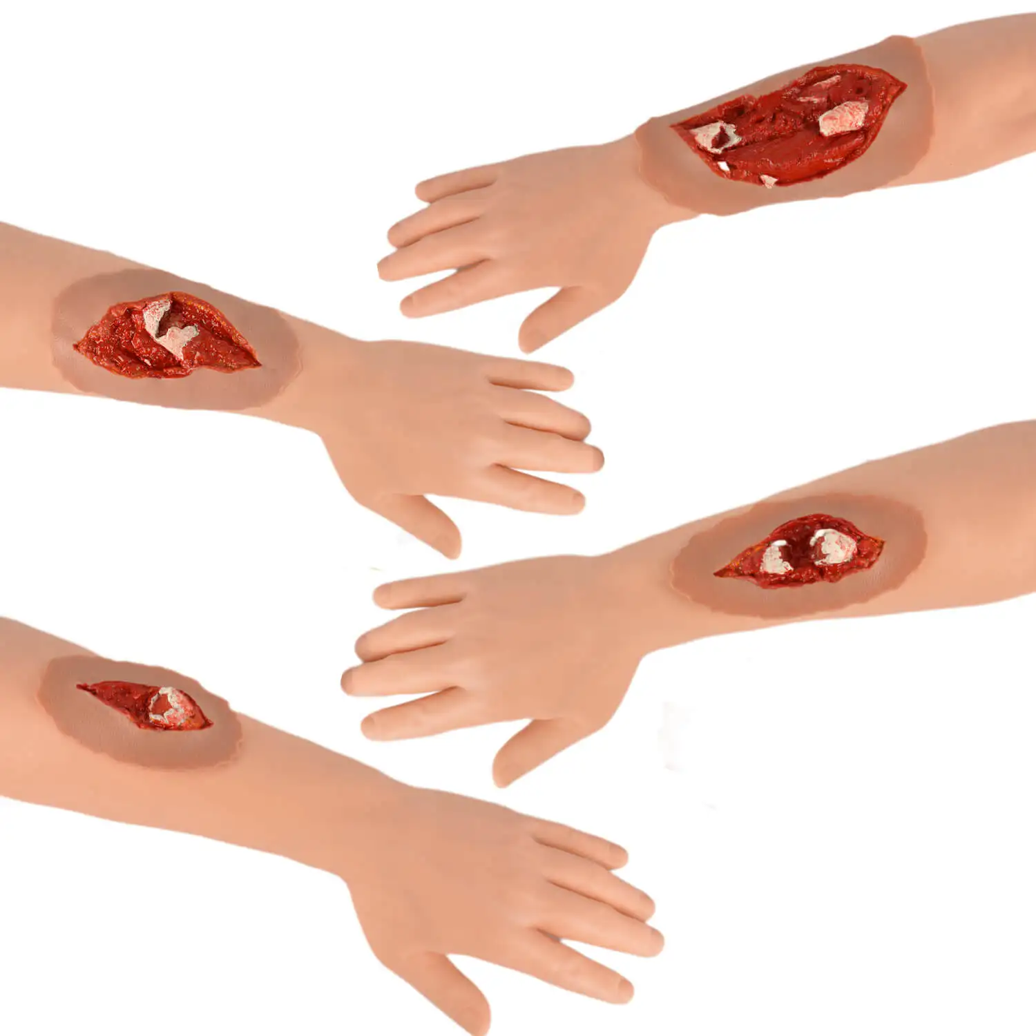 Ultrassist Open Fracture Wound Moulage Adhesive Model Grades II–V Wound Packing Dressing Training for Medical Education