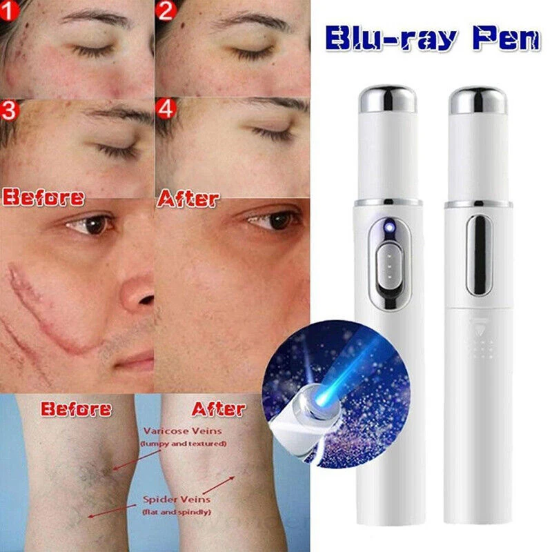 Portable Blue Light Pen Protects Face Cleanses Painless Laser Removes Scars Acne Marks Hot Selling