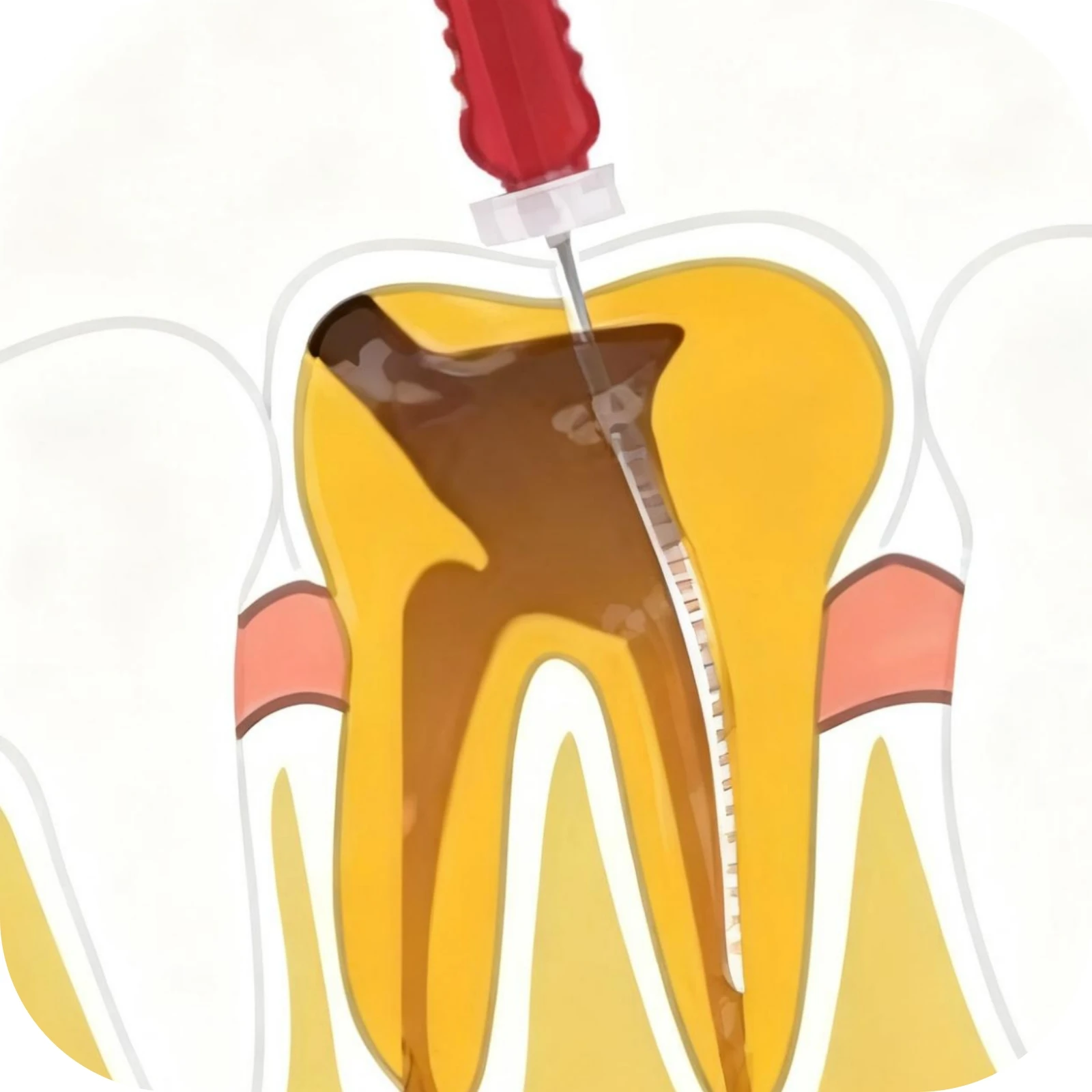 

Стоматологический эндофайл корневых каналов K-файлы/H-файл/развертки из нержавеющей стали для ручного использования 25 мм 6 шт./упак. ﻿