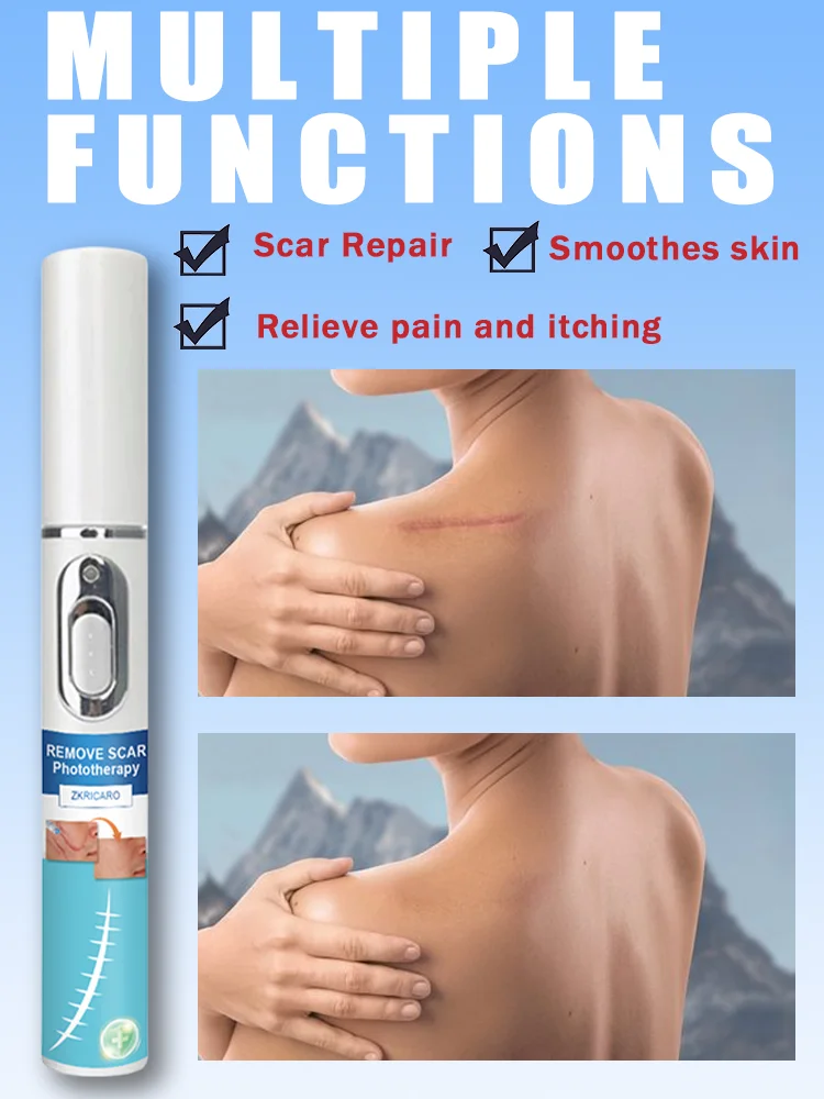 Magisch hellt Narben auf. Der professionelle Narbenlaserstift hilft Ihnen, dass die perfekte Haut immer noch sicher und effizient und schmerzlos ist