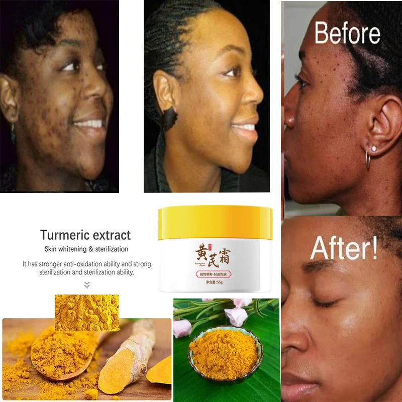 Whitening Freckles Face Cream Removal Melasma Dark Spots Corrector Lighten Melanin Pigmentation Brighten Anti-Aging Beauty Care