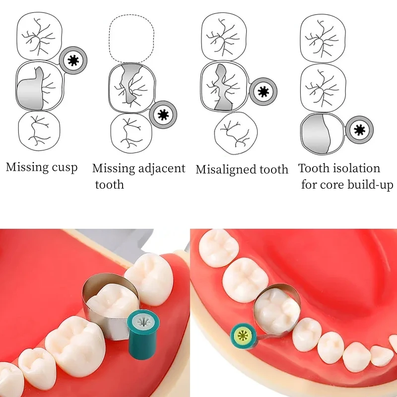 50 szt. Matryc dentystycznych z matrycą stalową dwustronnie wyprofilowane anatomicznie ukształtowane opaski matrycowe z gałką dentystyczną