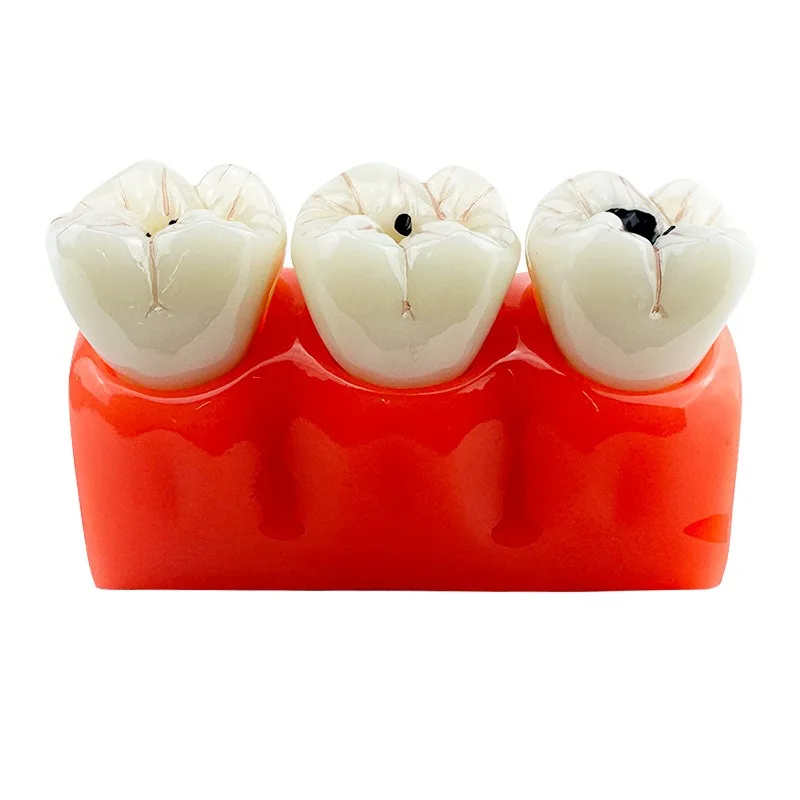 Red 4x caries decomposition model teaching tooth model detachable observation neurodental learning model