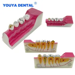 Dental Decomposition model Anatomy Study Model Molar Cross Section of lower right posterior teeth Teaching Training Practice