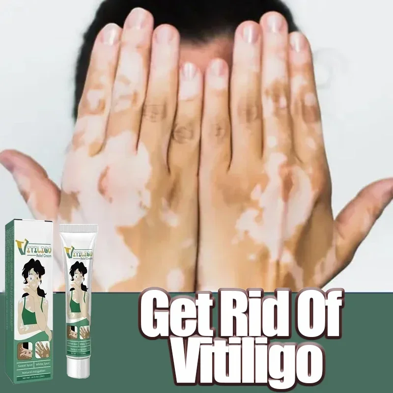 Vitiligo Removal Products, Remova a pele branca, Elimine a pele do corpo