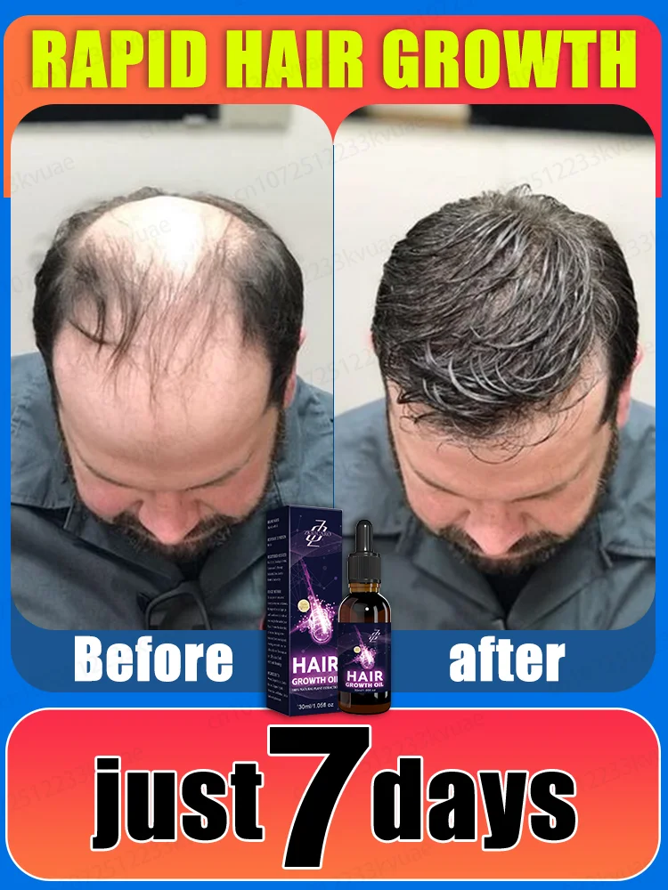 أزمة تساقط الشعر؟ الحل الأمثل لمشكلة الصلع، نمو الشعر بشكل جنوني، استعادة الشعر الكثيف!