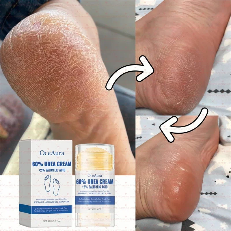 

60% Urea Feet Cream Extreme Dry Cracked Rough Thick Dead Skin 2% Salicylic Acid Soften Exfoliate Moisturizer Smooth Nourish Hand