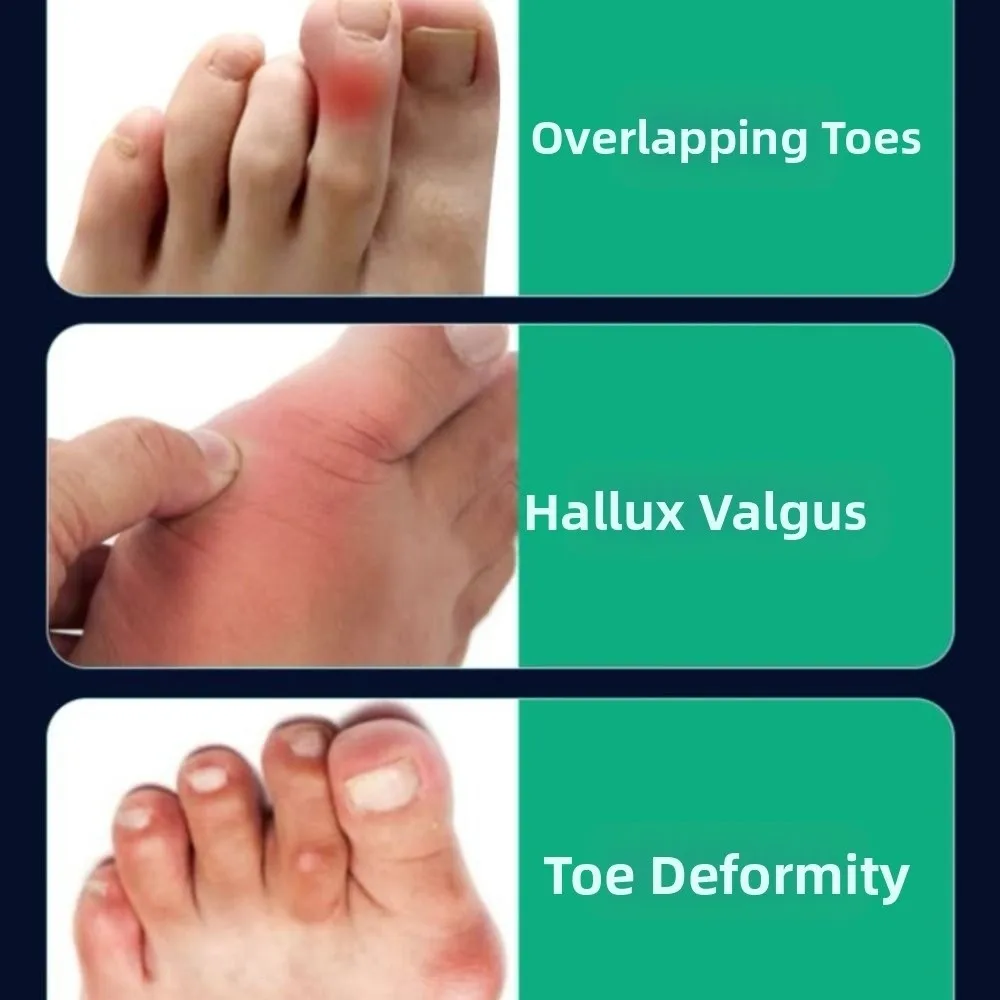 قابل للتعديل الورم مصحح الفرقة لينة تنفس كبير تو مستقيم تو أروح خلع كسر تصحيح القدم هدفين