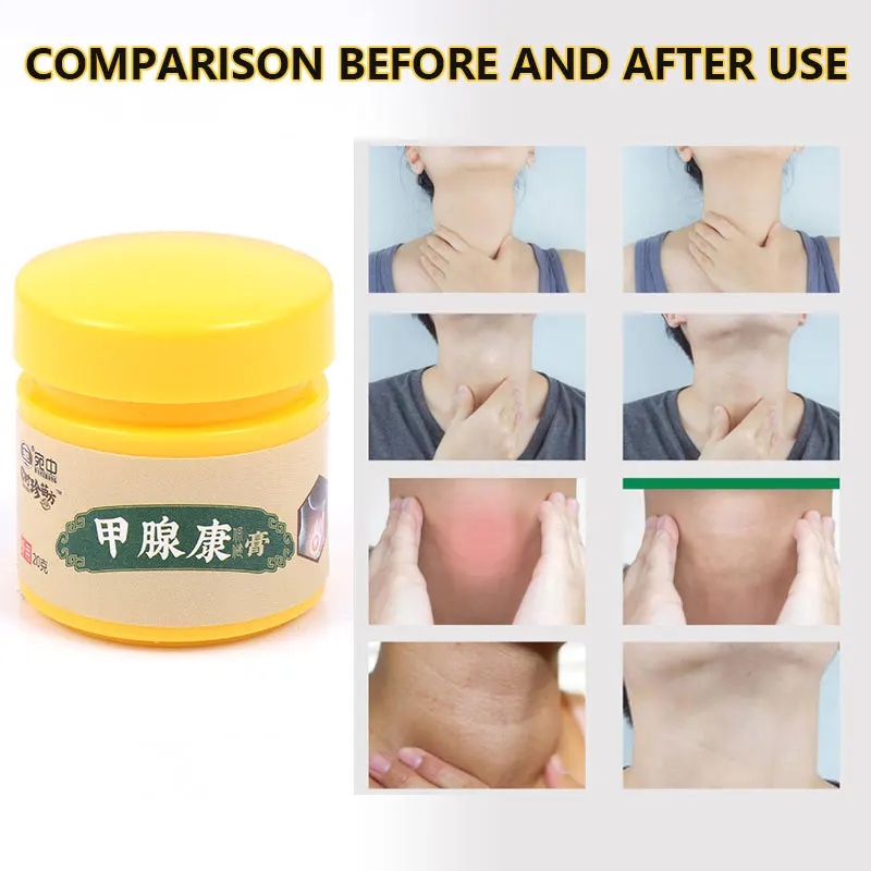 Thick Neck Thyroid Cream Lymphatic Lump Nodule Pain Lymphatic Cream Deep Penetration Chinese Herbal Medicine Cream