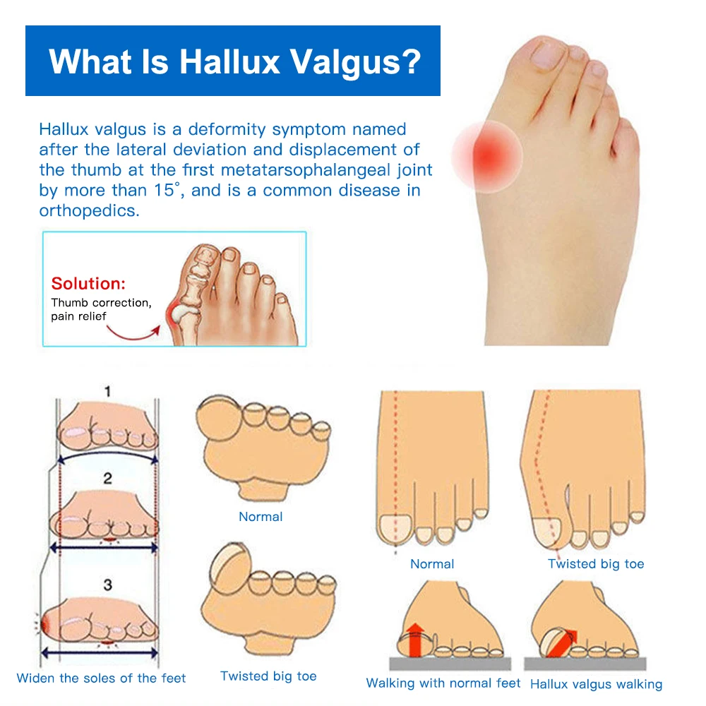 Corrector de pulgar de Gel de silicona, separador de juanetes, Protector de Hallux Valgus, alisador de dedos, ajustador, herramientas para el