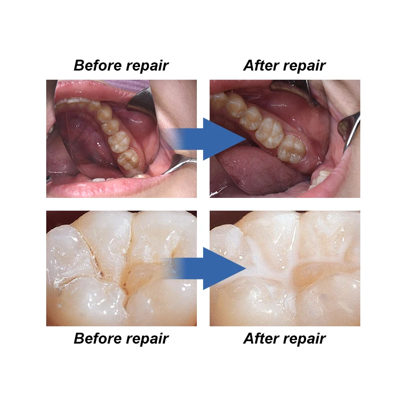 Рисунок 3 - VVDental Dental Pit Fissure Герметик