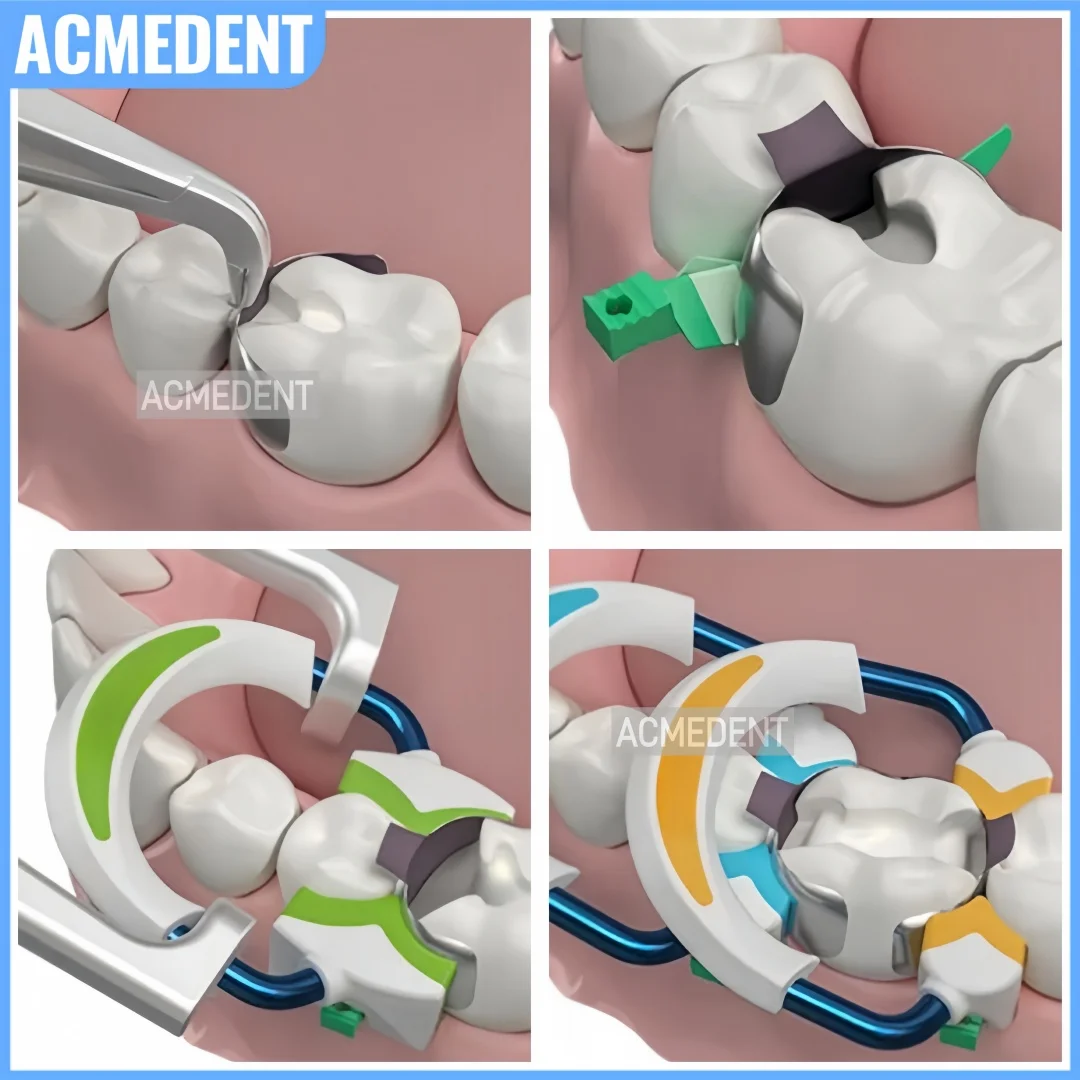 Dental Endo Composite Wedge Interdental Strata Wedges Soft Cervical Seal Diastema Matrix 270° Sealing Adaptive Tooth Restoration - Detail 1