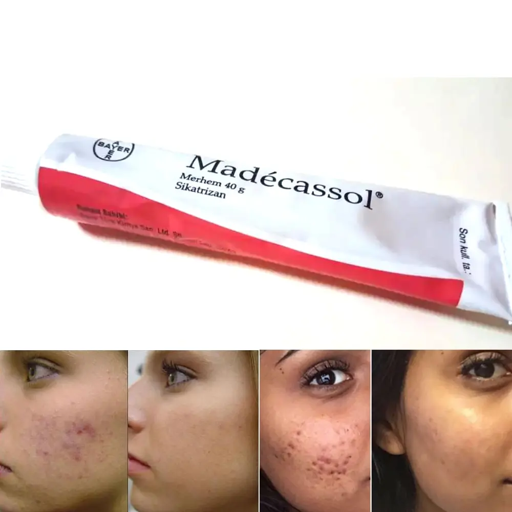 Madecassol-Crema de efecto mágico, bálsamo de Sikatrizan, Centella, regenerador de células asiáticas, acné, granos, lesión, dolor en la piel, rejuvenecimiento de la piel, 40 g