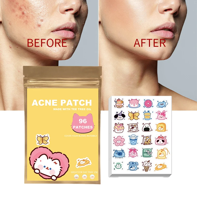 96pcs Acne Patches Cartoon Cat Shaped Acne Treatment Sticker Invisible Acne Cover Removal Pimple Patch Skin Care