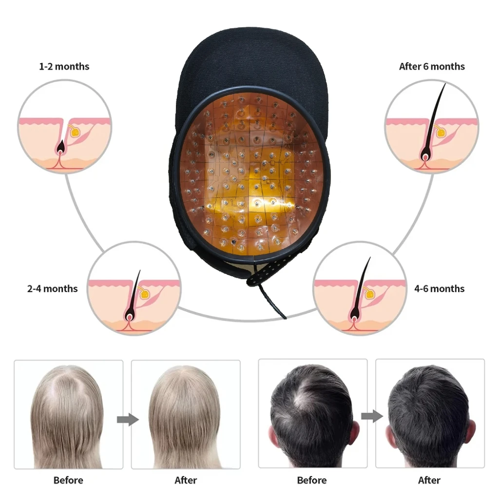 

Professional 96 Laser Diodes Hair Growth Cap LLLT Therapy Device For Men Women Anti Hair Loss Hat Fast Results