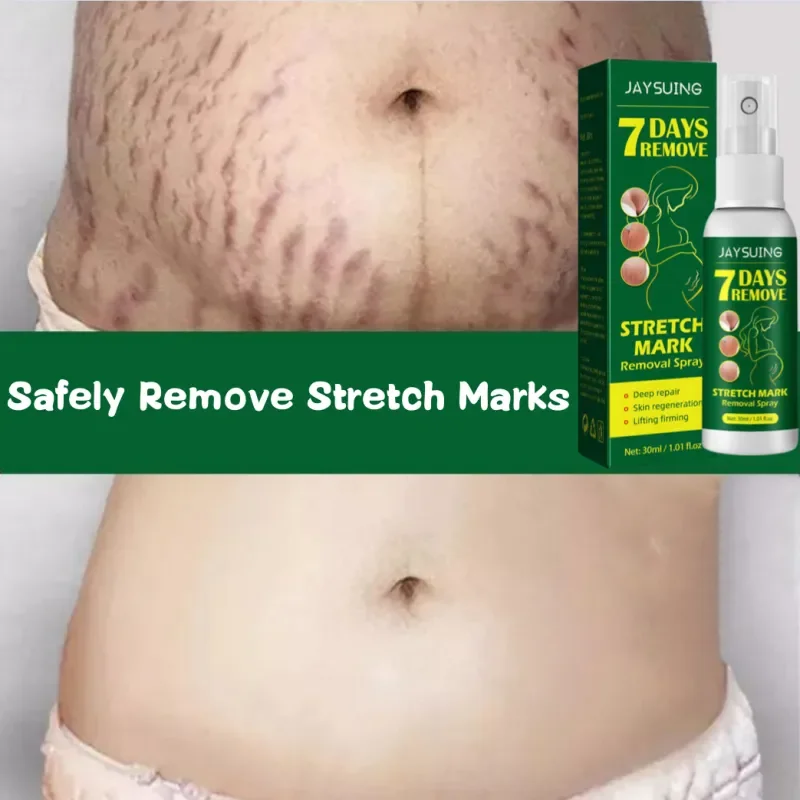 7 Days Stretch Marks Spray For Pregnancy Remove Postpartum Obesity Women Scar Without Side Effect Butt Firm Lift Skin Body Cream