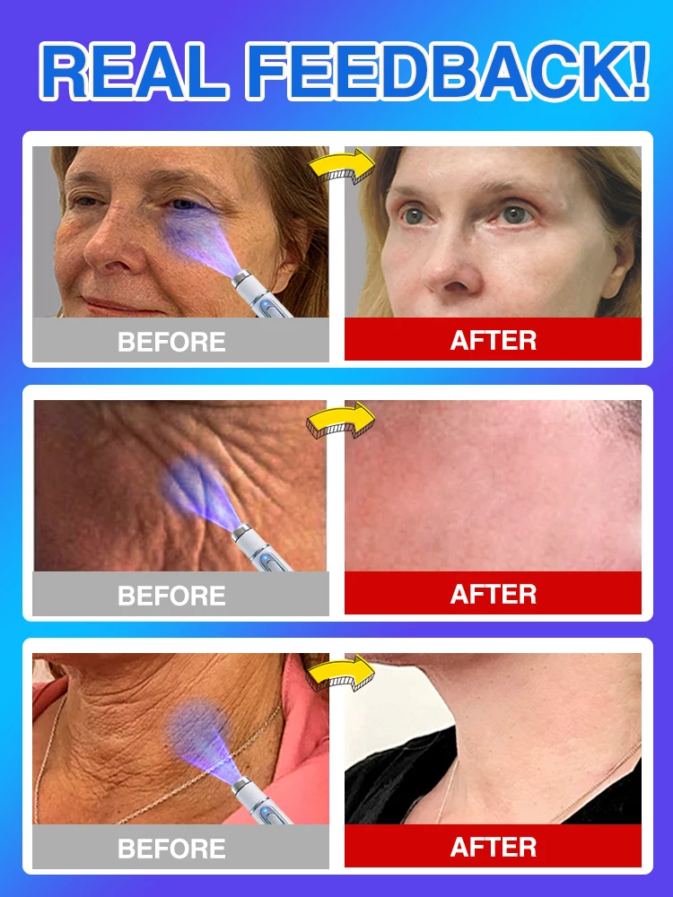 ลบริ้วรอยบนใบหน้าอย่างมีประสิทธิภาพและปรับปรุงความกระชับ