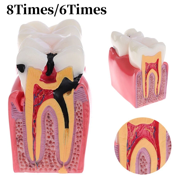 

8/6Times Dental Teeth Model Caries Comparative Study Denture Tooth Model Dentistry Dentist Teaching Studying Demonstration Model