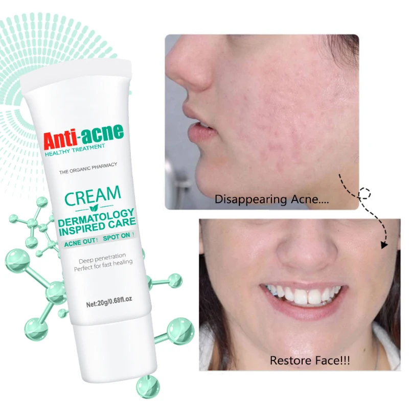 Salicylic Acid Acne Removal Cream Anti-Acne Repair Redness Pimple Spots Deep Cleaning Pore Oil Control Moisturizing Skin Care
