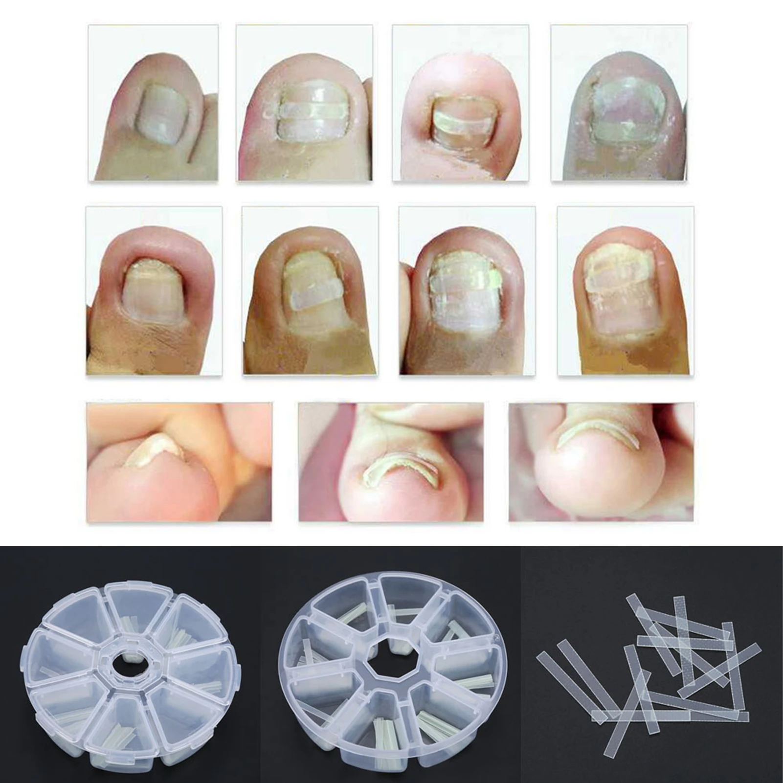 120 pièces/boîte autocollant incarné outil de soin des pieds pédicure incarné ongle redressage pince orteil autocollant pour ongles Patch outil de Correction