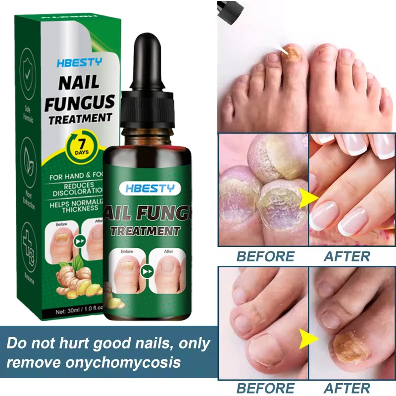 Nail Repairing Liquid Essence Hand Care Foot Fungal Removal Repair Serum Anti-infective Paronychia Nail Polish Repair Products