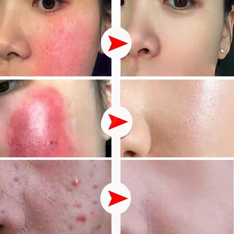 Crema reparadora de Rosacea y RedBlood para el cuidado de la piel, crema reparadora de rojeces faciales eficaz, tratamiento calmante para el acné, mejora la hidratación sensible, ilumina la piel