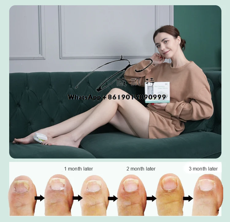 HY-30DS hot selling mini device for toenail fungal podiatric laser treatment